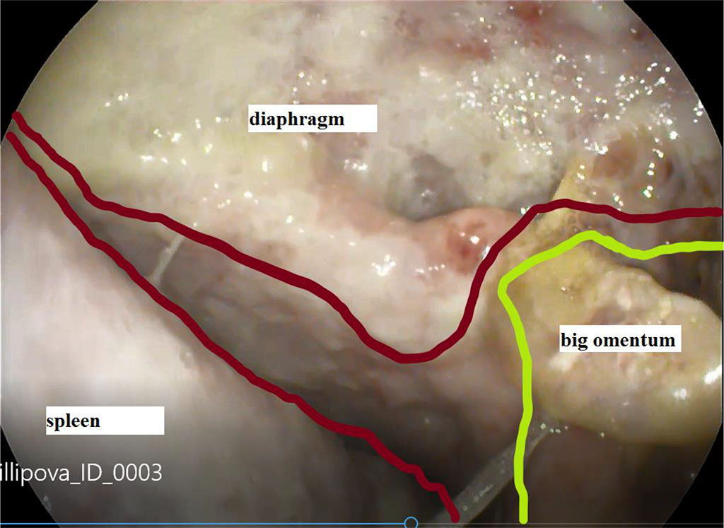 Figure 1. View of the abscess cavity of the left subdiaphragmatic space through a defect in the failure of gastric sutures