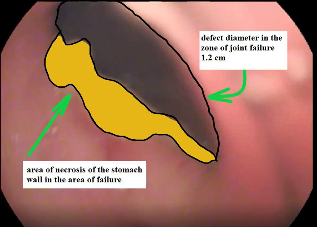 Figure 2. View of a gastric suture defect with a zone of near-wound necrosis at the time of detection