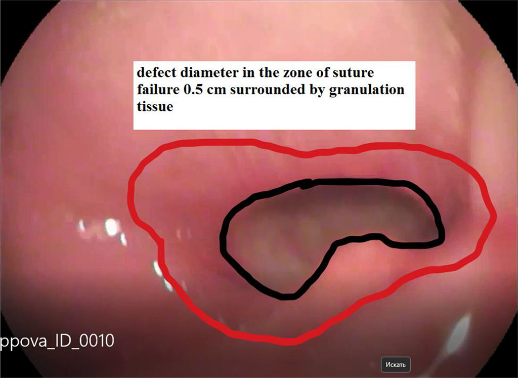 Figure 3. View of the defect 7 days after the start of the vacuum endoscopic treatment