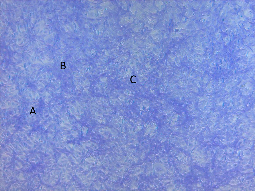Figure 1. Photomicrograph of MCF-7DOX cells: without photobiomodulation and without doxorubicin. Cell growth with the formation of anastomoses (A), layering (B), cells of symplast-type structures (C).
