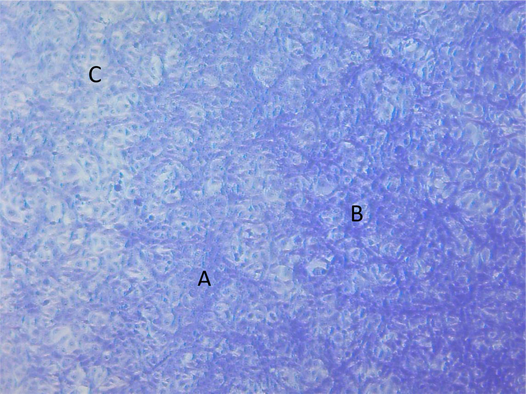 Figure 3. Photomicrograph of MCF-7DOX cells: doxorubicin without photobiomodulation. Fields of solid growth of tumor cells (A) with the formation of anastomoses (B) and separate areas of thinning (C).
