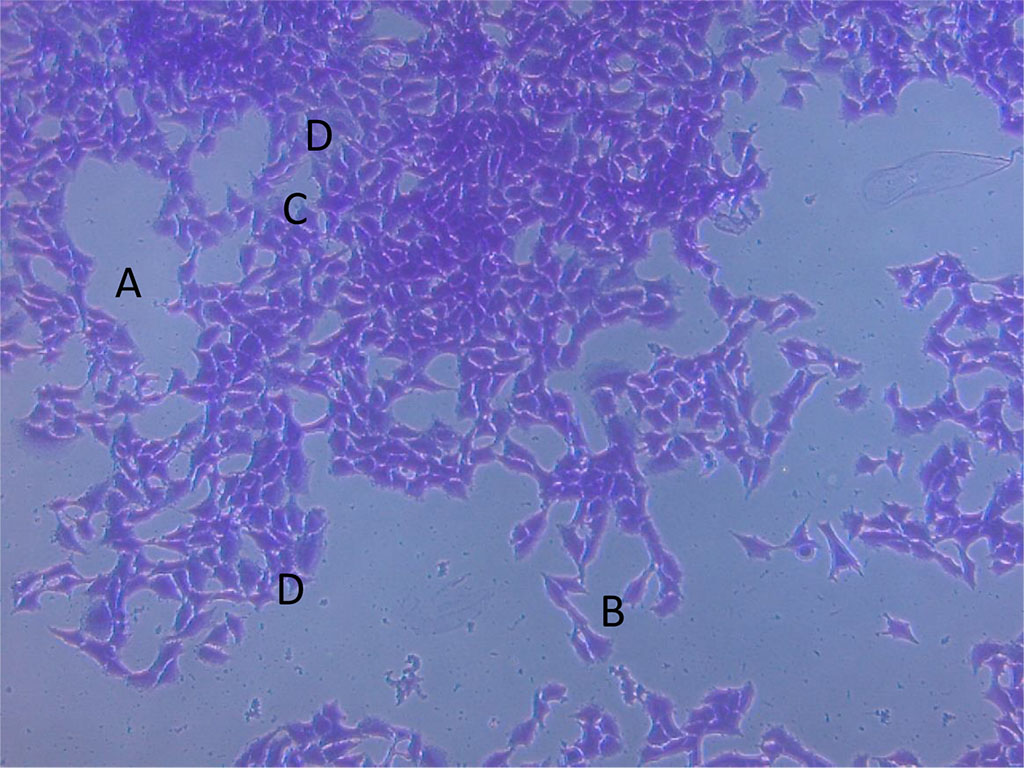 Figure 4. Photomicrograph of MCF-7DOX cells: photobiomodulation + 2.0 μg doxorubicin. Loss of connections between growing tumor cells with the formation of large cavity structures (A); groups of cells and individual cells (B); cells with torn membranes and stratified cytoplasm (C), giant cells with large nuclei (D).