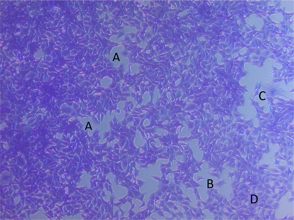 Figure 5. Photomicrograph of MCF-7DOX cells: photobiomodulation + 0.5 μg doxorubicin. Areas of rarefaction alternating with solid areas of tumor cells growth (A); formation of cavities and separation of separate groups of cells and single cells (B); giant cell (C); deformed cells with damaged membranes (D).