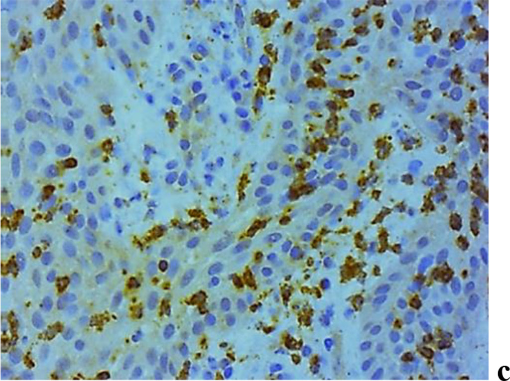 Figure 10. Immunohistochemical staining with antibodies to MMP-2(a), MMP-8(b), MMP-9 (c) in the gum biopsy material in children with inflammatory periodontal pathology and mild UCTD; ×500 (chromogen − DAB, Mayer hematoxylin counterstaining).