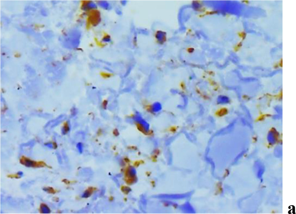 Figure 11. Immunohistochemical staining with antibodies to MMP-2(a), MMP-8(b), MMP-9 (c) in the gum biopsy material obtained from children with inflammatory periodontal pathology and mild UCTD; ×500 (chromogen − DAB, Mayer hematoxylin counterstaining).