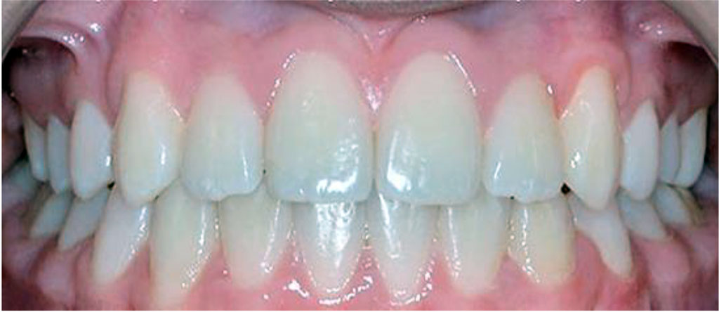 Figure 5. Patient K., 17 y.o. (comparison group). Clinically healthy periodontium and a “good” (OHI-S = 0.4) level of oral hygiene