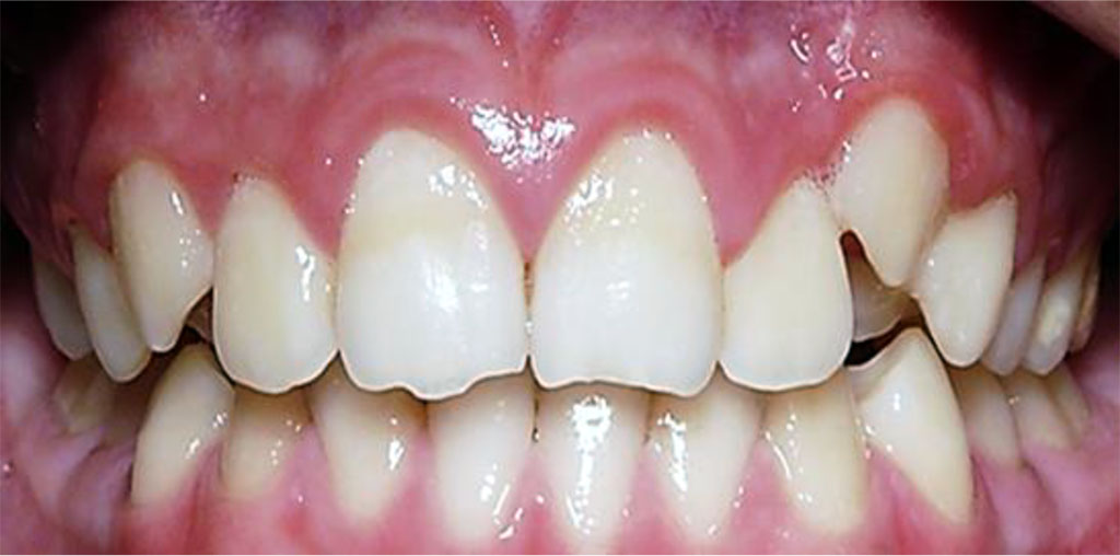 Figure 6. Patient P., 14 y.o. (mild UCTD; points scored – 11 (L.N. Abbakumova, 2006)). Ds: chronic gingivitis (catarrhal) K05.1 (ICD-10) and moderate (PMA index – 32.4 %), oral hygiene – satisfactory (OHI-S = 0.9).