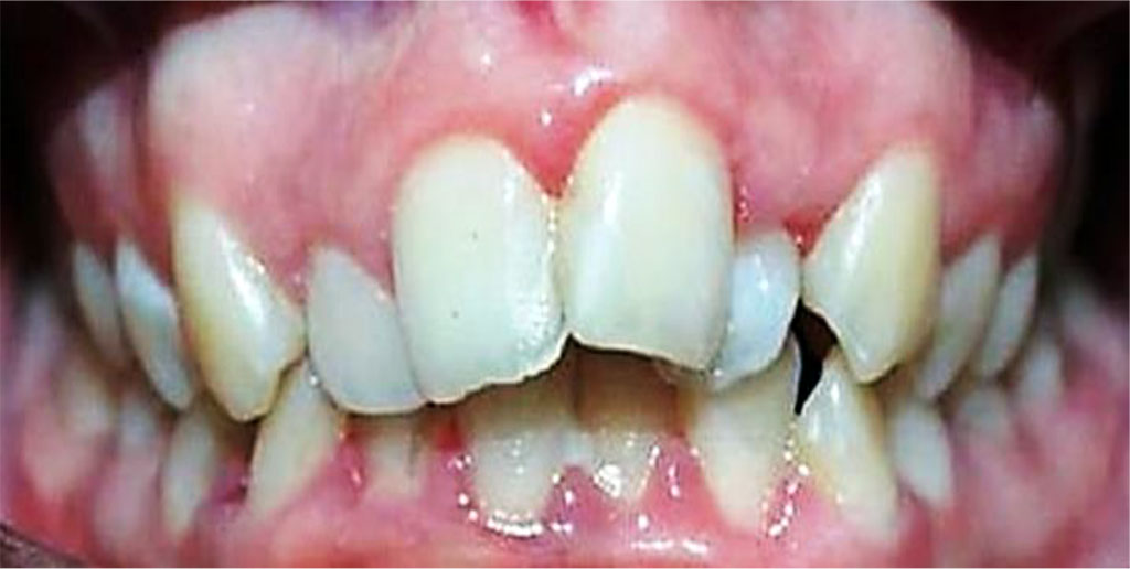 Figure 7. Patient А., 16 y.o. (moderate UCTD; points scored – 19 (L.N. Abbakumova, 2006)). Ds: chronic gingivitis (catarrhal) K05.1 (ICD-10) and moderate (PMA index – 35.8 %), oral hygiene – satisfactory (OHI-S = 0.9).