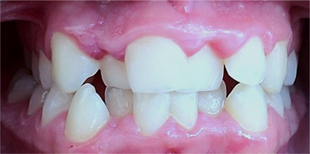Figure 8. Patient B., 15 y.o., significant degree of UCTD; points scored – 25 (L.N. Abbakumova, 2006)). Ds: chronic gingivitis (catarrhal and hypertrophic) K05.1 (ICD-10) moderately severe (PMA – 43.9 %), oral hygiene – satisfactory (OHI-S = 1,1).