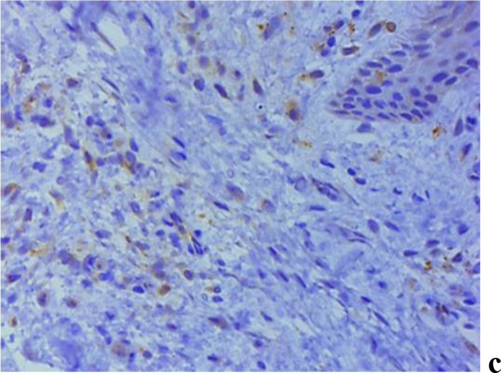 Figure 9. Immunohistochemical staining with antibodies to MMP-2(a), MMP-8(b), MMP-9 (c) in gum biopsy material in children with intact periodontium with no clinical symptoms of UCTD; ×500 (chromogen − DAB, Mayer hematoxylin counterstaining).