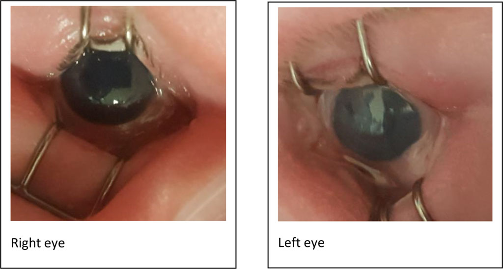 Figure 1. Photo showing hazy cornea (Left > right)