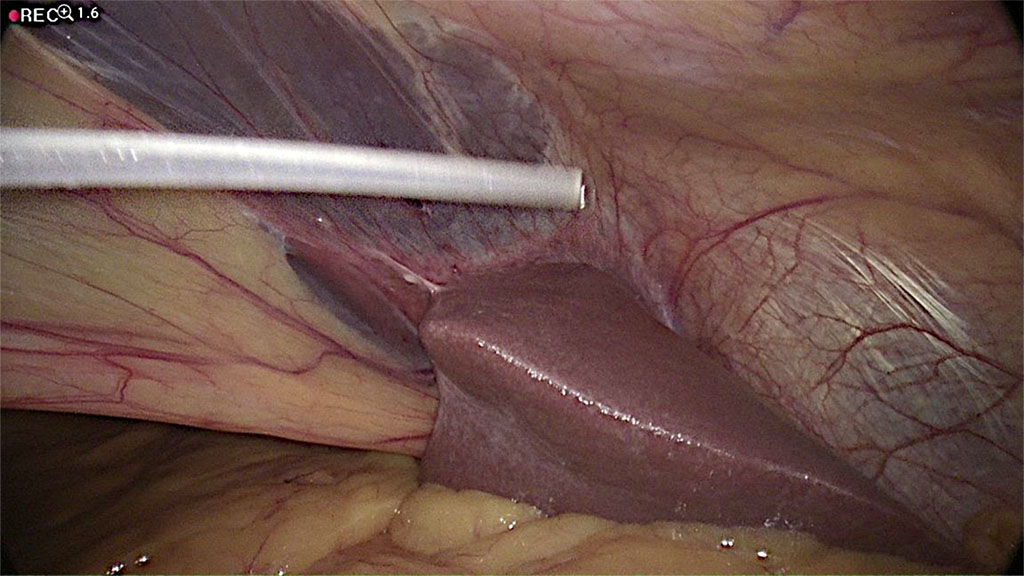 Figure 5 Catheter is passing through the hole in the falciform ligament. /Source: Author Content/