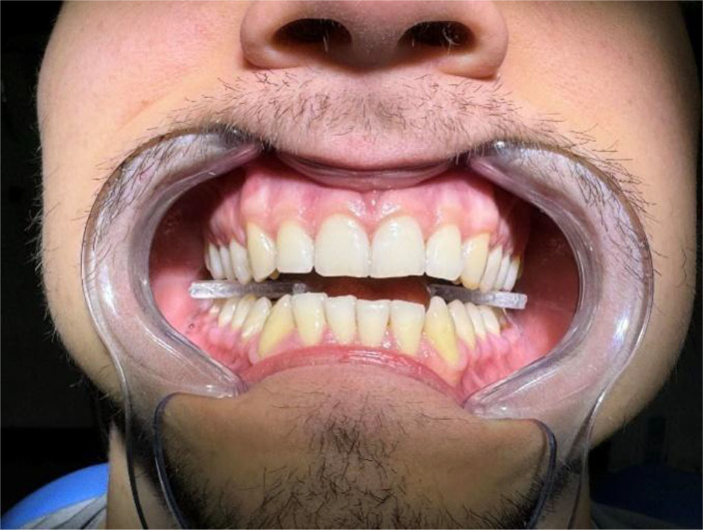 Fig.4.1 Patient with occlusal separators in occlusion. 