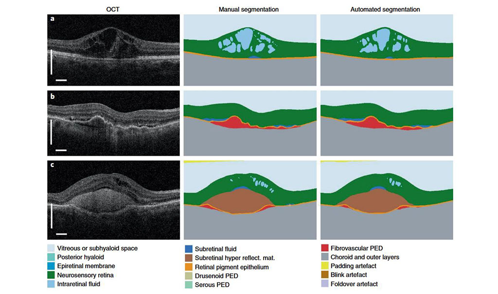 Fig. 1 | Results of the segmentation network. Three selected two-dimensional slices from the n = 224 OCT scans in the segmentation test set (left) with manual segmentation (middle) and automated segmentation (right; detailed color legend in Supplementary Table 2). a, A patient with diabetic macular edema. b, A patient with choroidal neovascularization resulting from age-related macular degeneration (AMD), demonstrating extensive fibrovascular pigment epithelium detachment and associated subretinal fluid. c, A patient with neovascular AMD with extensive subretinal hyperreflective material. [17]. 