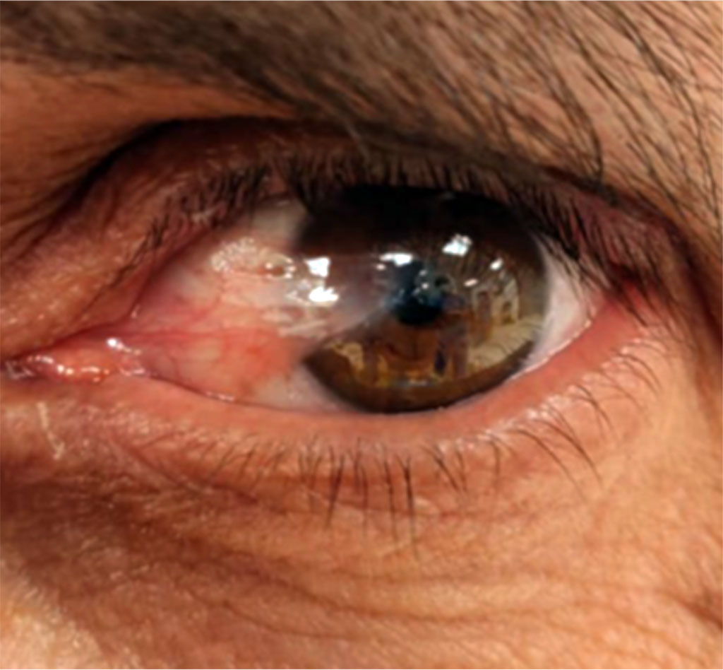 Figure 1. Advanced pterygium of left eye.