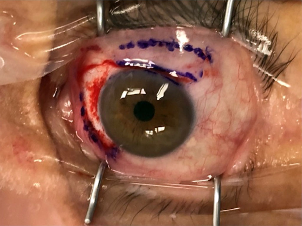 Figure 2. Scleral wound post pterygium removal and superior conjunctival flap planning.