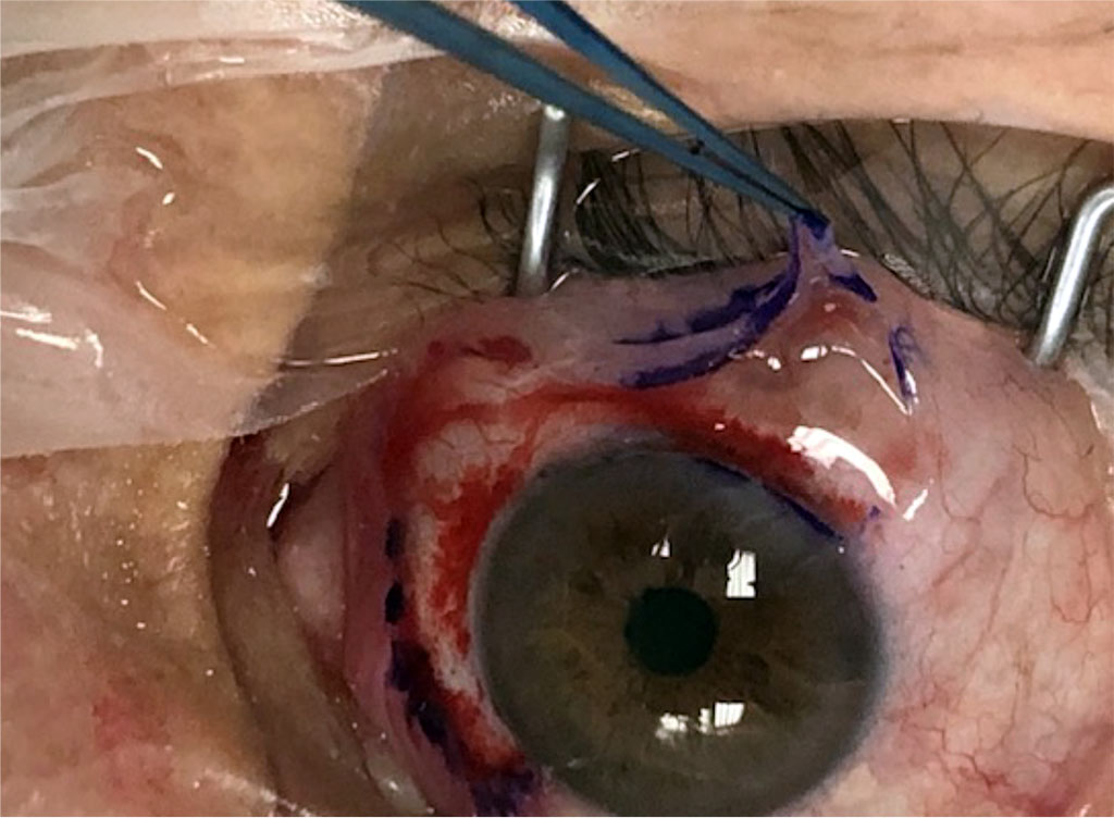 Figure 3. Formation and transposition of superior conjunctival flap. 