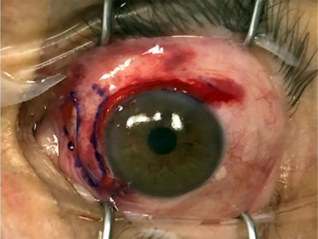 Figure 4A. Fixation of conjunctival flap to limbus and nasal sclera with Fibrin glue.