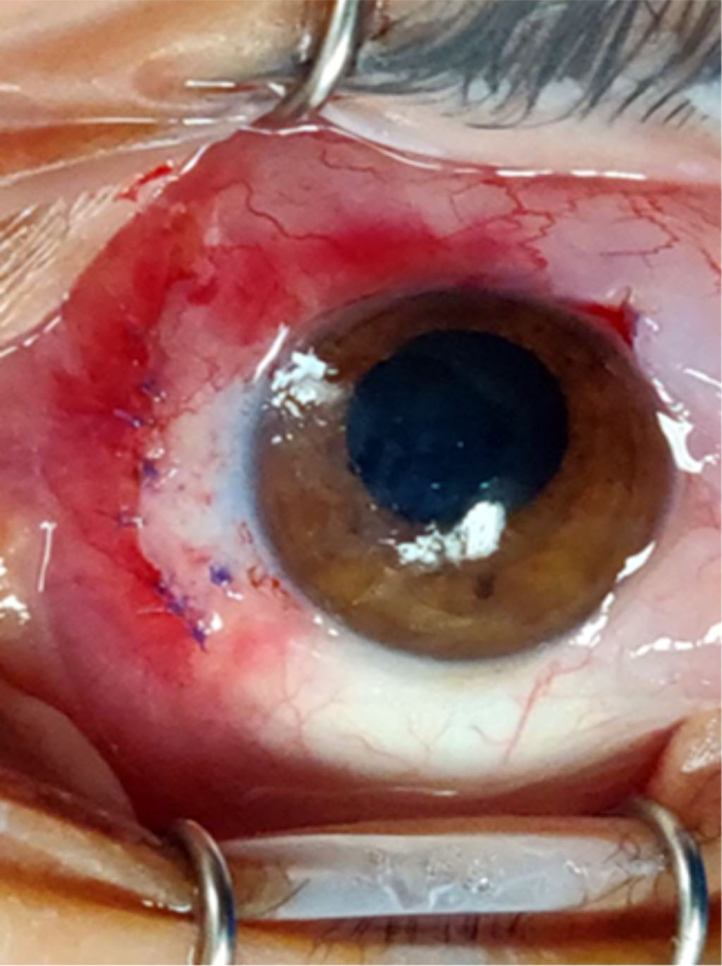 Fig. 4B Fixation of conjunctival flap to nasal sclera with Vicryl sutures. 
Both techniques had complete closure of wounds in the supra limbal area.