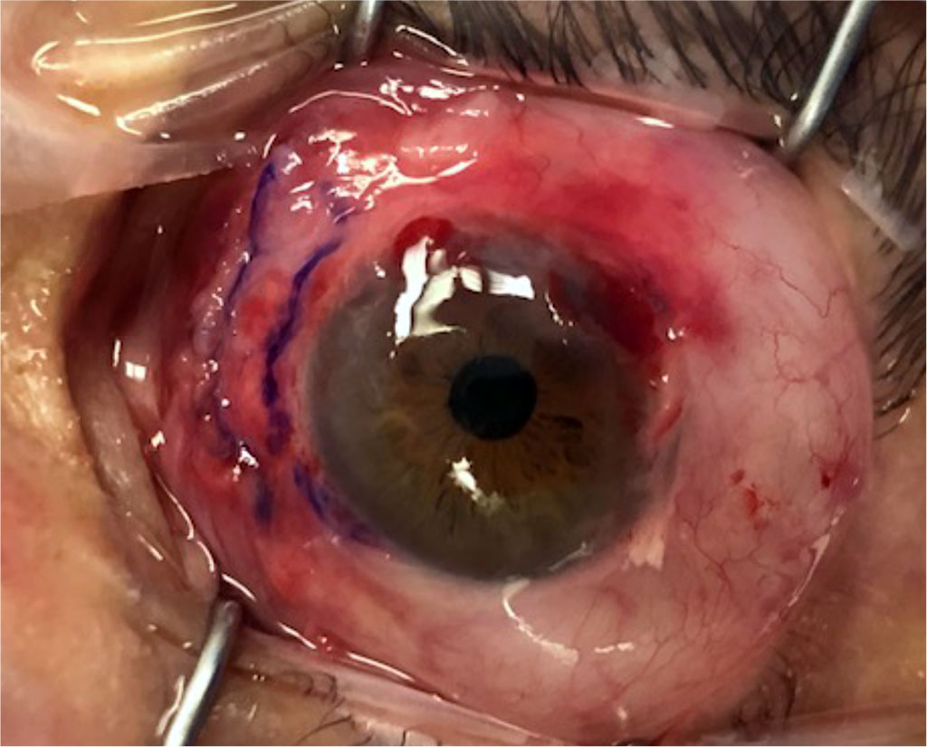 Fig 5 Additional fibrin glue application on corneal surface for Fibrin contact lens formation.