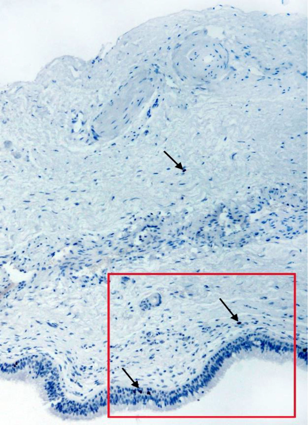 Fig. 2. Section of the membrane from the anterior wall of the maxillary sinus of a 46-year-old man. IHC staining for the Ki-67 antigen. Magnification 100X. Arrows indicate positive cells.