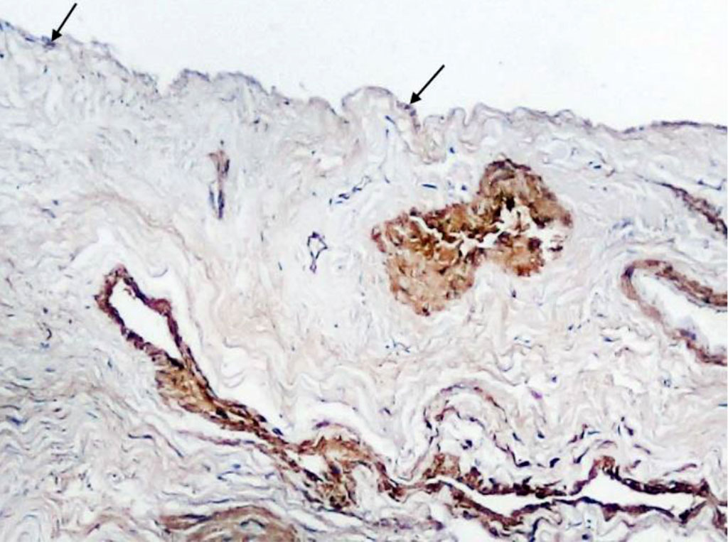 Fig. 3. Section of Schneiderian membrane from the anterior wall of the maxillary sinus of a 51-year-old man, obtained during microantrotomy. IHC for a-SMA. Magnification 200X. Cells with positive expression of a-SMA (indicated by arrows).