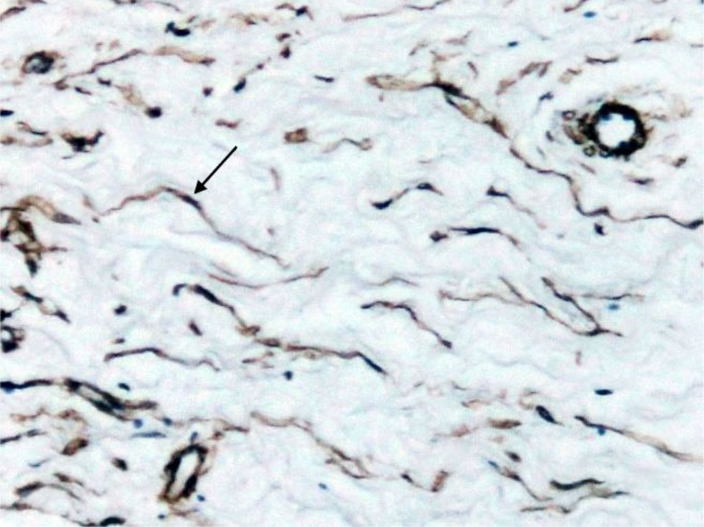 Fig. 4. Section of Schneiderian membrane from the anterior wall of the maxillary sinus of a 56-year-old man, obtained during microantrotomy. IHC for a-SMA. Magnification 400X. Cells with positive expression of a-SMA (indicated by arrows).