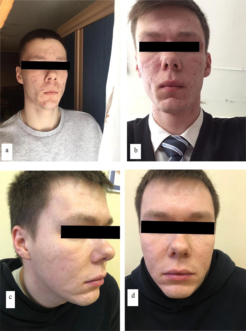The patient (I) before the treatment (a, b) 