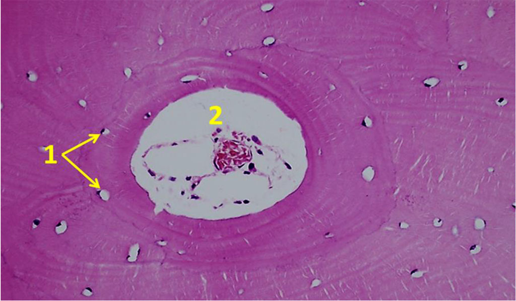 Figure 11. Orientation of osteocytes in relation to the Haversian canals on histological preparations of the intact bone from the maxillary tuberosity area (×100; hematoxylin-eosin stain; 1– osteocytes; 2 – Haversian canal).