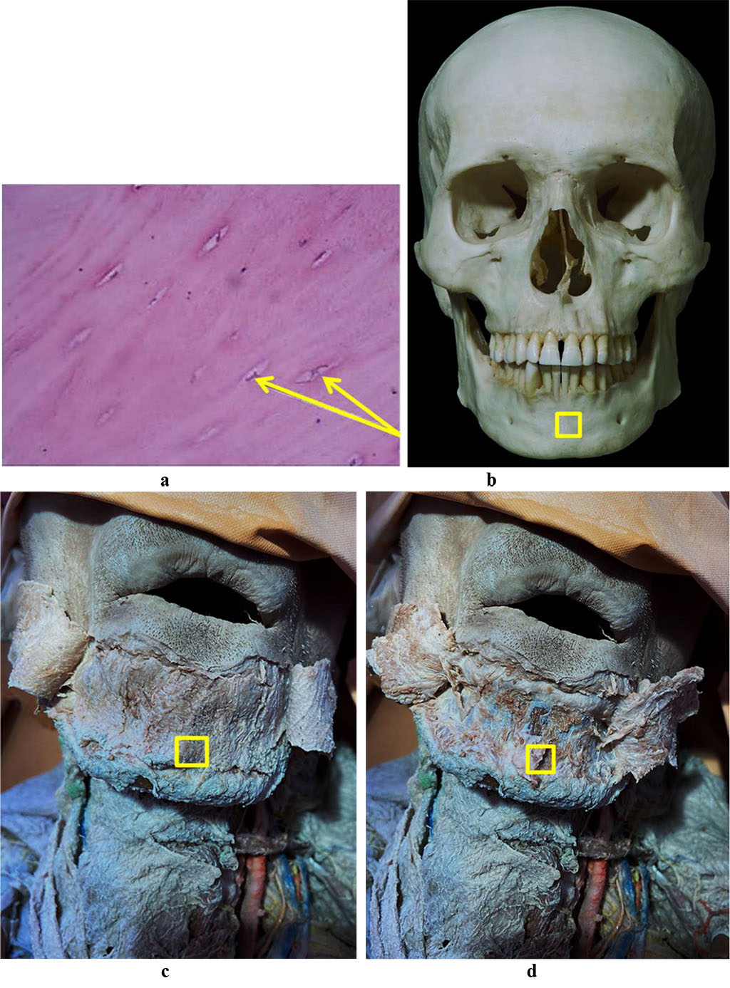 Figure 4. Bone biopsy taken from the chin symphysis area: a – a histological preparation of intact bone from the chin symphysis area (×400, hematoxylin-eosin staining; osteocytes indicated by arrows); b – a section of the mandible donor zone to obtain a chin autograft; c – an anatomical preparation after the skin flap detachment; d – an anatomical preparation after the muco-periosteal flap detachment.