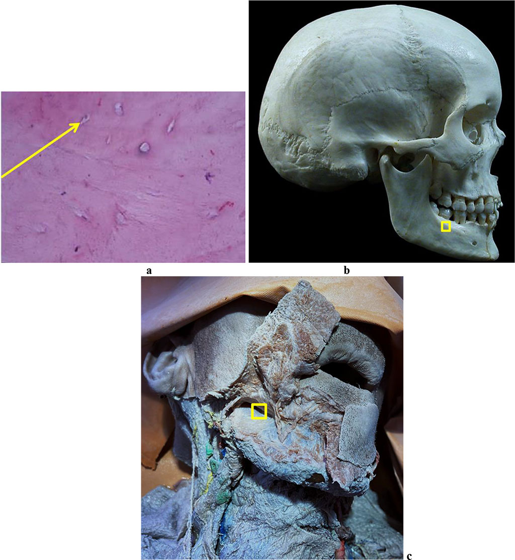 Figure 5. Bone biopsy from the mandible outer oblique line area: a – a histological preparation of intact bone from the mandible outer oblique line area (×400, hematoxylin-eosin stain, osteocyte indicated by the arrow); b – a section of the donor zone for obtaining an autograft from the mandible outer oblique line area; c – an anatomical preparation after the muco-periosteal flap detachment.