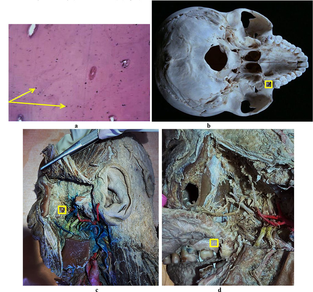 Figure 6. Bone biopsy obtained from the maxillary tuberosity area: a – histological preparation of intact bone taken from the maxillary tuberosity area (×400, hematoxylin-eosin staining, osteocytes indicated by an arrow); b – a donor zone section in order to obtain an autograft from the maxillary tuberosity area; c – an anatomical preparation after the fasciocutaneous flap detachment; d – an anatomical preparation after the muco-periosteal flap detachment.
