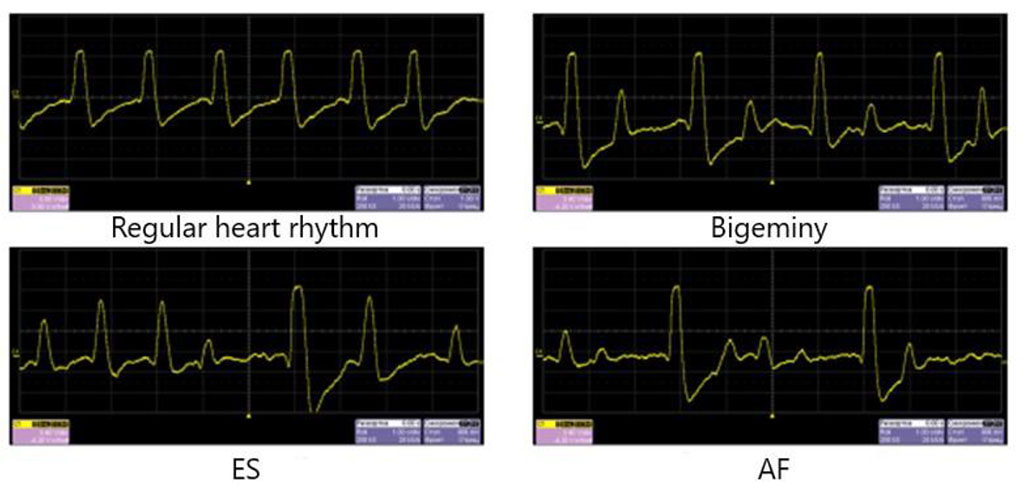 Figure 5. Pressure data for regular heart rhythm and heart arrhythmias simulation. There is an increase in pressure in the first post-extrasystolic wave and during the passage of the pulse wave after a long pause in AF.