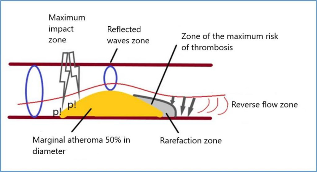 Figure 7. Scheme of pressure distribution on atheroma during ES or AF simulation. Note: p! – the maximum pressure.