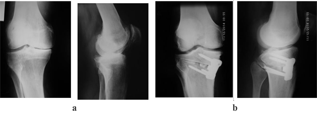 Figure 1: photoprints of radiographs of patient P., 55 years old, with a diagnosis of III stage left-sided gonarthrosis. varus deformities of the left knee joint. a – before surgery; b - after surgery: supratuberous valgus osteotomy of the right tibia, with bone autoplasty and МОС ХМ plate