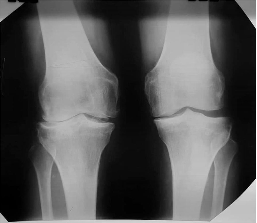 Figure 2. Radiographs of the knee joints before the operation in the loaded state.