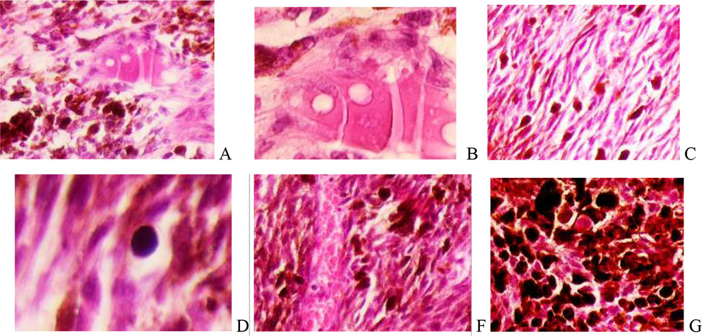 Figure 2. Melanoma of the choroid and ciliary body of the human eye. A, B - Epithelioid cells surrounded by melanocytes. C-spindle tumor cells. F and G – containing melanin. Hematoxylin and eosin staining. Magnification A, C, F, G x200; B, D x400.