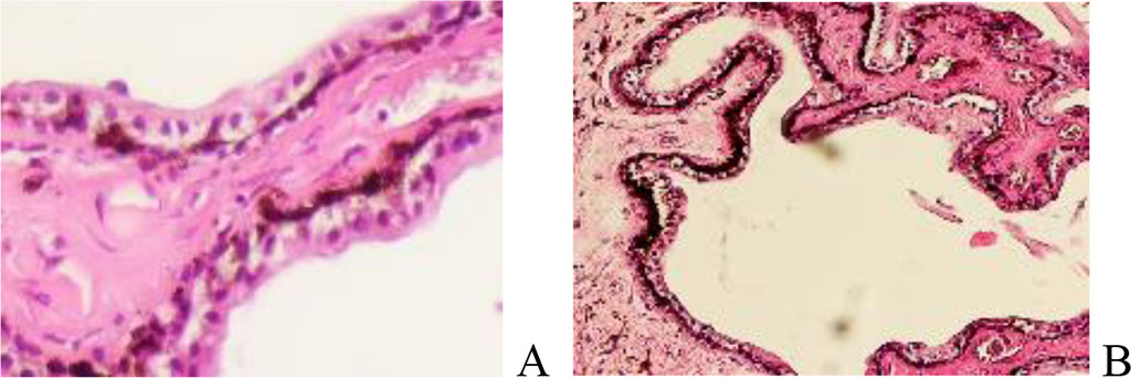 Figure 3. Ciliary process. Melanoma of the choroid and ciliary body of the human eye. Hematoxylin and eosin staining. Magnification A x400; B x100.