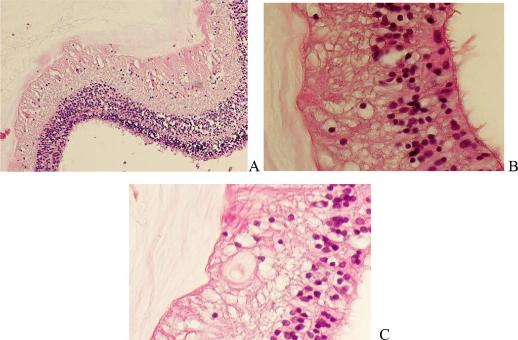 Figure 4. Detachment of the human retina against the background of melanoma of the choroid and ciliary body of the human eye. Hematoxylin and eosin staining. Magnification A x100; B x200; Сх400.