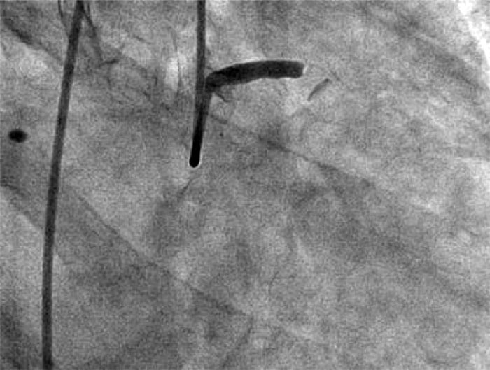 Fig. 1. LCA trunk occlusion