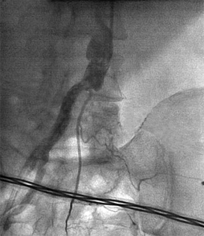 Fig. 2. Left iliac artery occlusion