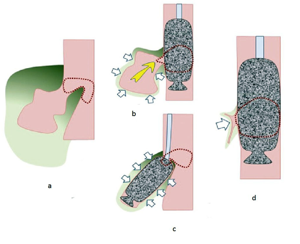 Fig. Schematic arrangement of the vacuum aspiration system. a - anastomotic failure (marked by a dotted line) with the presence of a cavity (red color) and inflammatory changes in the surrounding tissues (green color); b - installation of a vacuum aspiration system in the lumen of the esophagus. The yellow arrow indicates the direction of evacuation of the contents from the cavity. White arrows indicate the direction of retraction of adjacent tissues under the influence of negative pressure created in the porous system. The dotted line marks the configuration of the anastomotic line with the vacuum aspiration system installed; c - installation of a vacuum aspiration system in the cavity near the site of the leak. The designations are the same; d - changes in the anastomosis and surrounding tissues at the stages of treatment. The designations are the same. 