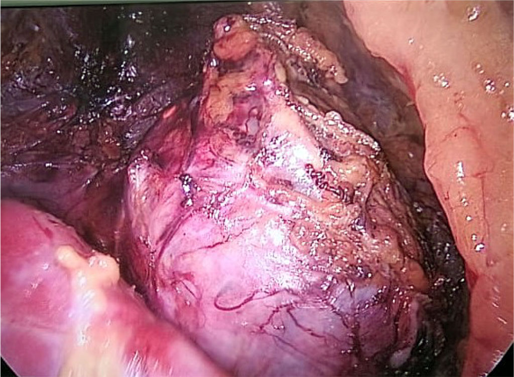 Figure 2. Intraoperative image of a pheochromocytoma of the right adrenal gland