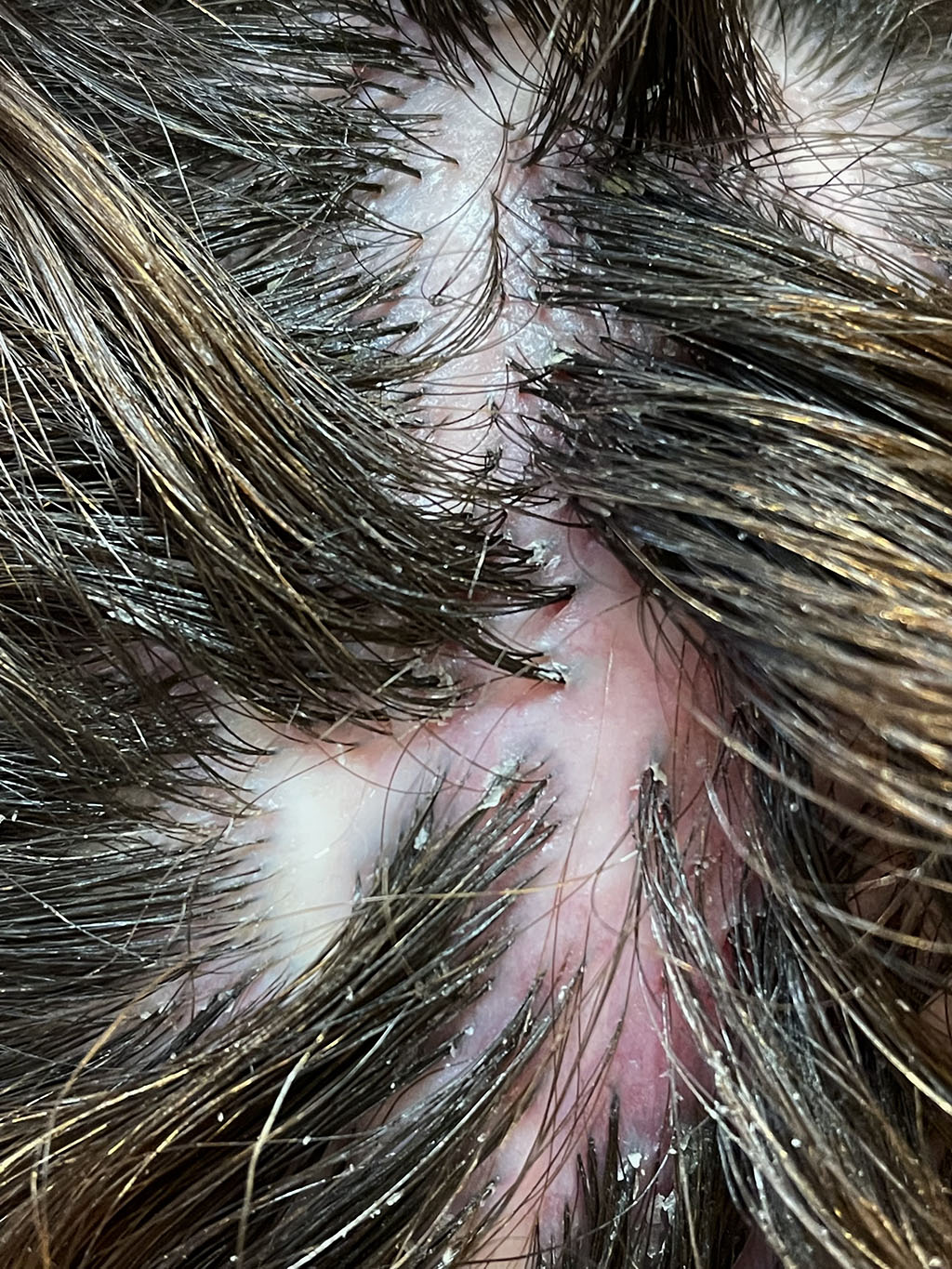 Fig 3. – Epithelization of ulcer defect with the formation of scarring alopecia. Tufted hair growth.