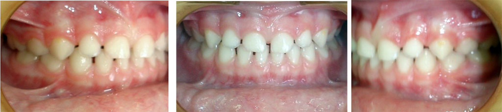 Figure 1 – Оcclusal characteristics in participants with optimal functional occlusal norm