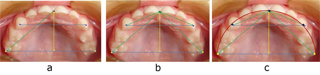 Figure 2 – Major reference marks for measuring baby bite dental arches (a), geometric construction of diagnostic triangles (b) and graphic reproduction (c)