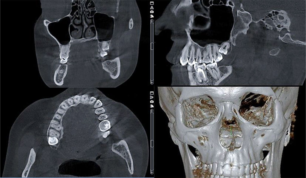 Fig. 1. Dentition CBCT, case of dentoalveolar transversal divergent occlusion