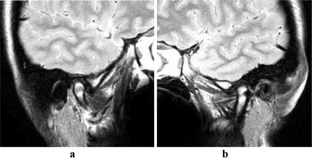 Fig. 11. Patient V., MRI, right (a) and left (b) TMJ, oblique sagittal projection; following splint treatment