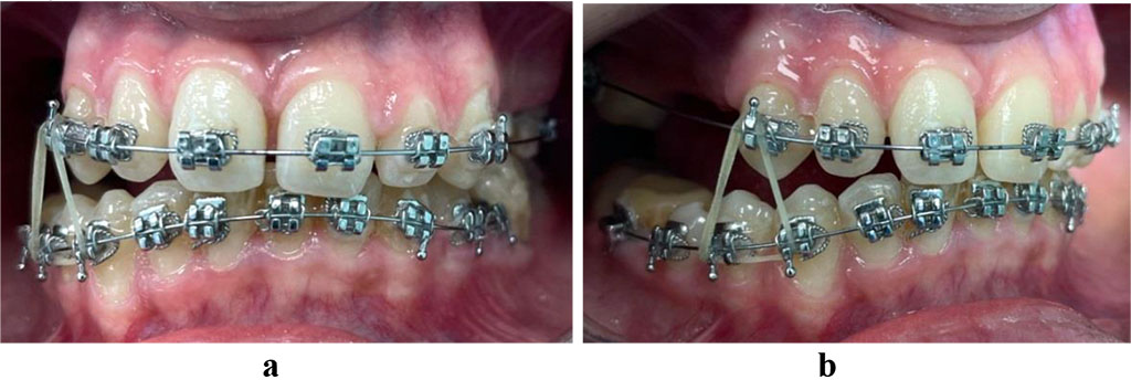 Fig. 13. Patient V., intermaxillary elastics applied on the right (a, b) when treating dentoalveolar transversal divergent occlusion