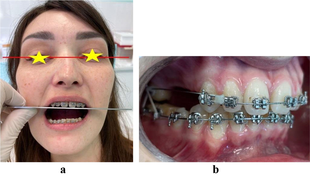 Fig. 14. Patient V., occlusal plane changed azimuth, face photo (a) and oral cavity (b) through the treatment of dentoalveolar transversal divergent occlusion
